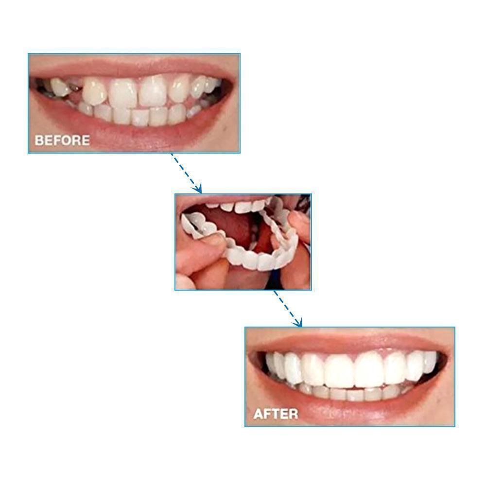 1 SET OF DIAMOND SMILE VENEERS (TOP & BOTTOM TEETH)