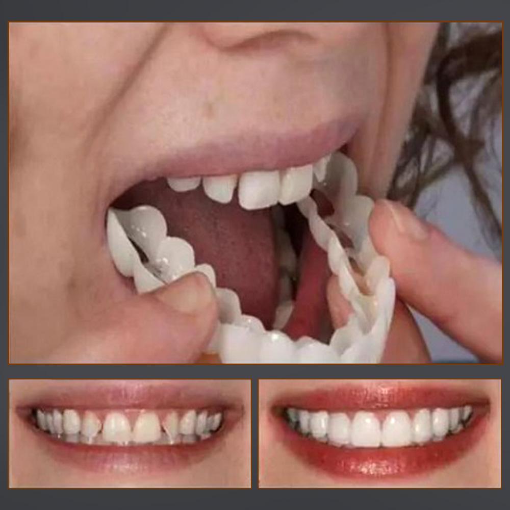 1 SET OF DIAMOND SMILE VENEERS (TOP & BOTTOM TEETH)